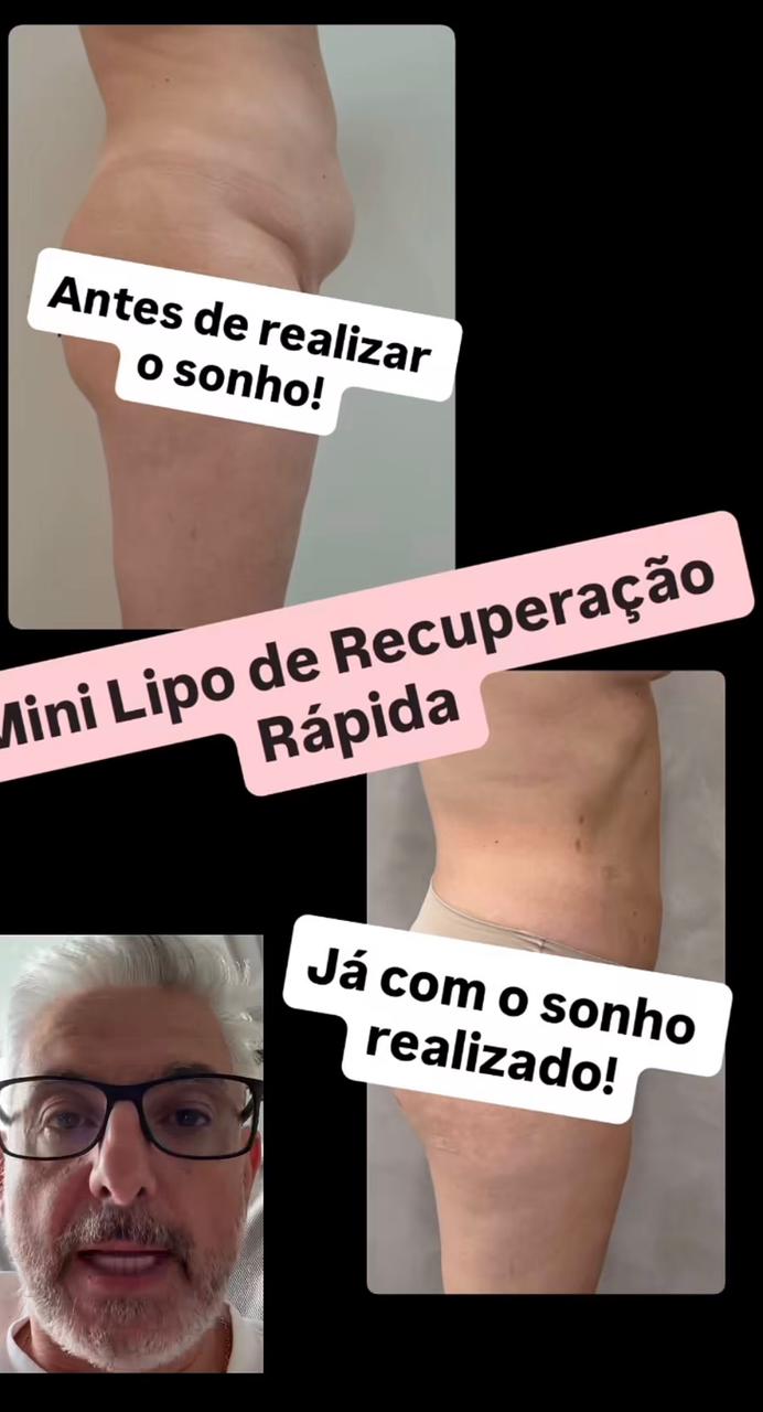 Resultado Mini Lipo